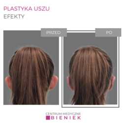 Plastyka uszu - efekty