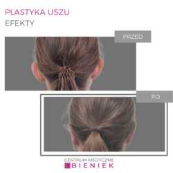 Plastyka uszu - efekty