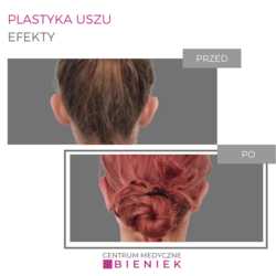 Plastyka uszu - efekty