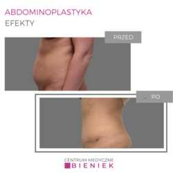 Abdominoplastyka - efekty