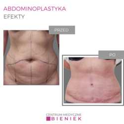 Abdominoplastyka - efekty