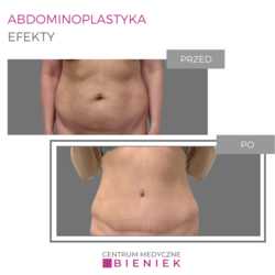 Abdominoplastyka - efekty