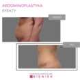 Abdominoplastyka - efekty