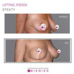 Lifting piersi - efekty