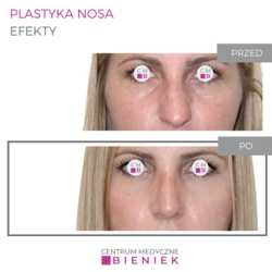 Plastyka nosa - efekty