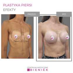 Plastyka piersi - efekty