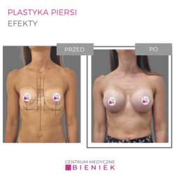 Plastyka piersi - efekty