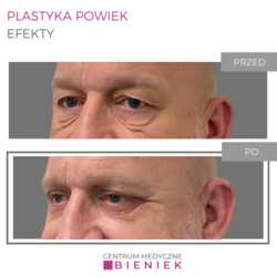 Plastyka powiek - efekty