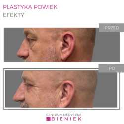 Plastyka powiek - efekty