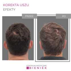 Korekcja uszu - efekty