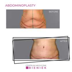 Abdominoplasty - efekty