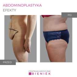 Abdominoplastyka - efekty