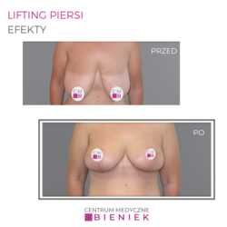 Lifting piersi - efekty