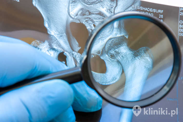 Rodzaje endoprotez stawu biodrowego dobiera się indywidualnie, biorąc pod uwagę wiek pacjenta, jakość kości oraz poziom aktywności fizycznej