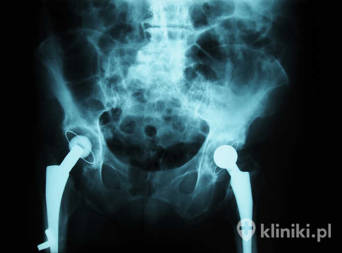 Żywotność endoprotezy stawu biodrowego najczęściej wynosi 15–20 lat, choć nowoczesne implanty często funkcjonują znacznie dłużej