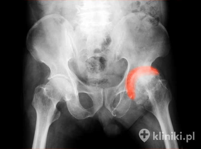 Rozwój choroby zwyrodnieniowej stawu biodrowego bywa następstwem chorób wieku rozwojowego i zaburzeń osi kończyny