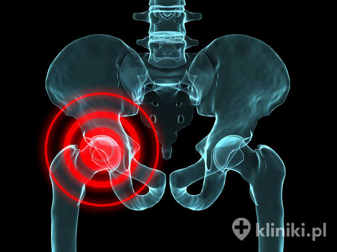 Kapoplastyka biodra może ułatwiać powrót do sprawności i naturalnego zakresu ruchu po zabiegu