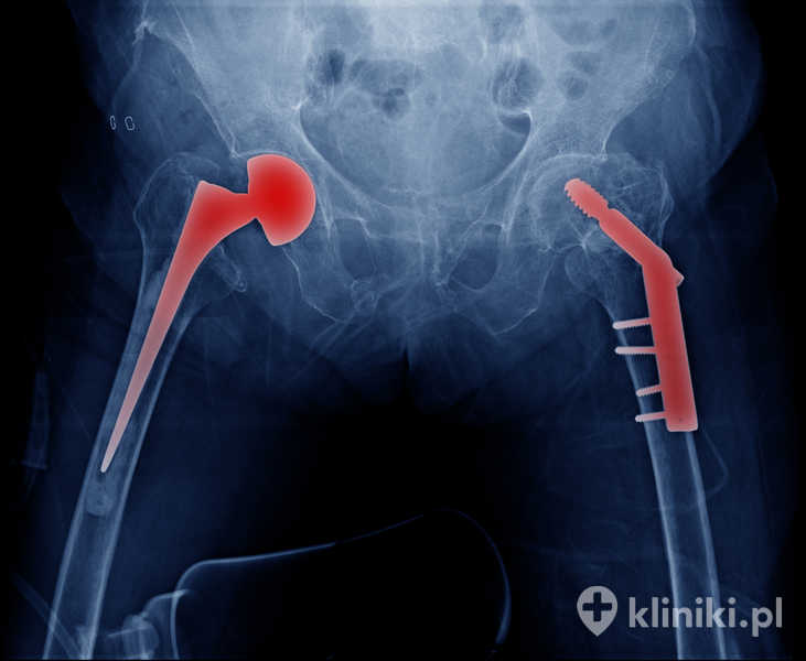 Endoprotezoplastyka bezcementowa biodra zapewnia długotrwałą stabilność implantu bez konieczności użycia cementu kostnego