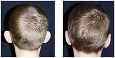 Korekcja odstających uszu przed i po zabiegu