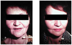 Lifting operacyjny przed i po zabiegu