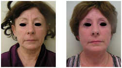 Lifting operacyjny przed i po zabiegu