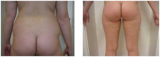 Liposukcja - odsysanie tłuszczu przed i po zabiegu
