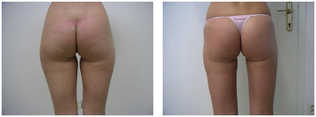 Liposukcja - odsysanie tłuszczu przed i po zabiegu