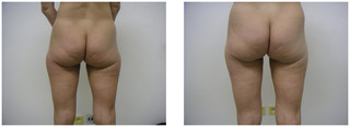Liposukcja pośladków przed i po zabiegu