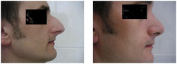 Operacje plastyczne nosa przed i po zabiegu