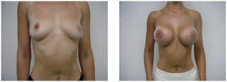 Operacje plastyczne piersi przed i po zabiegu