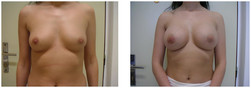 Powiększanie piersi implantami okrągłymi przed i po zabiegu