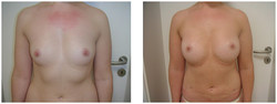 Powiększanie piersi własną tkanką tłuszczową przed i po zabiegu