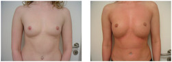 Powiększanie piersi własną tkanką tłuszczową przed i po zabiegu