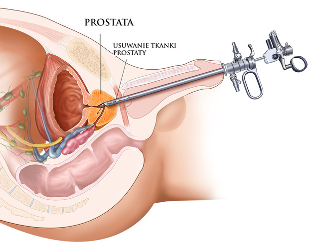 Prostata a erekcja