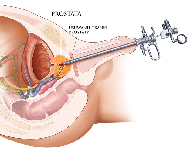 Przezcewkowa elektroresekcja prostaty TURP - rysunek poglądowy