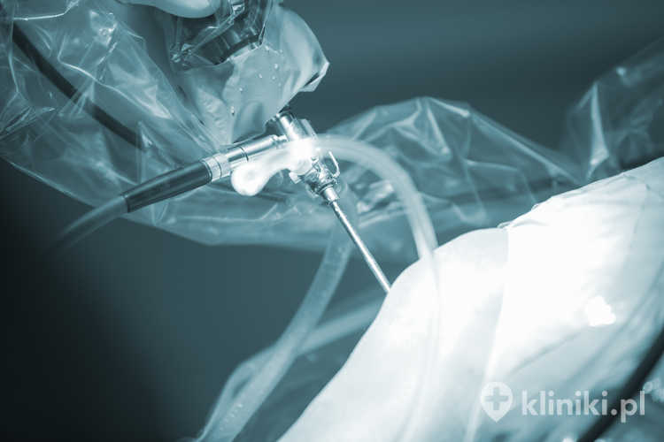 Artroskopia operacyjna łąkotki pozwala na precyzyjne usunięcie lub zszycie uszkodzonego fragmentu łąkotki przy minimalnym naruszeniu tkanek