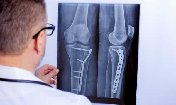 Implanty stosowane w endoprotezoplastyce stawu kolanowego często zawierają elementy polietylenowe wykonane z UHMWPE, które pełnią funkcję powierzchni stawowej i zmniejszają tarcie