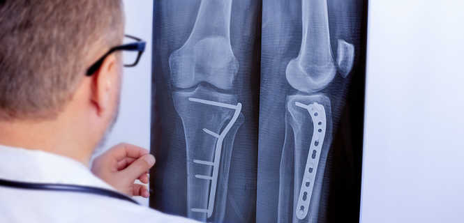 Implanty stosowane w endoprotezoplastyce stawu kolanowego