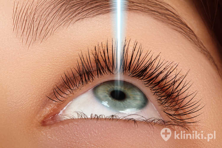 Wskazania do zabiegu ReLEx SMILE