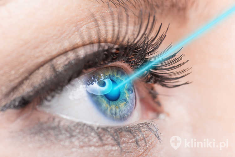 Trabekuloplastyka laserowa SLT polega na zastosowaniu lasera o niskiej energii działającego selektywnie na beleczkowanie oka, bez uszkadzania otaczających tkanek