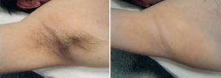Depilacja przed i po zabiegu