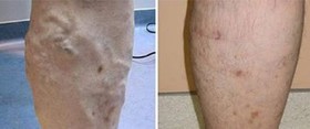 Laserowe leczenie żylaków nóg przed i po zabiegu