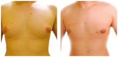 Leczenie ginekomastii przed i po zabiegu