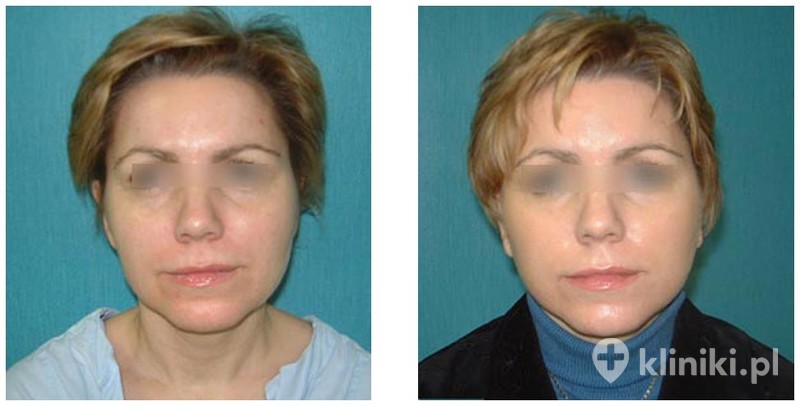 Lifting operacyjny twarzy i szyi - zdjęcia przed i po | Kliniki.pl