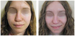 Operacje plastyczne nosa przed i po zabiegu