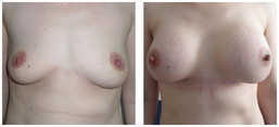 Operacje plastyczne piersi przed i po zabiegu
