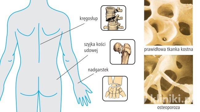 Osteoporoza - rysunek poglądowy
