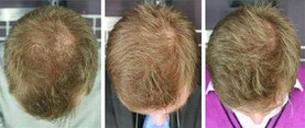 Skóra głowy - mezoterapia igłowa przed i po zabiegu
