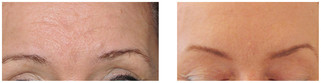 Usuwanie zmarszczek botoksem przed i po zabiegu