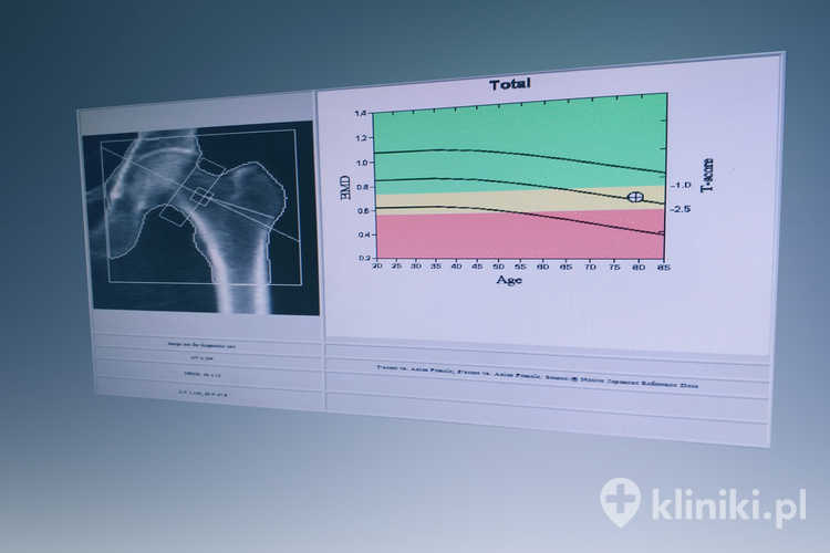 Zastosowanie leku Bonviva w osteoporozie